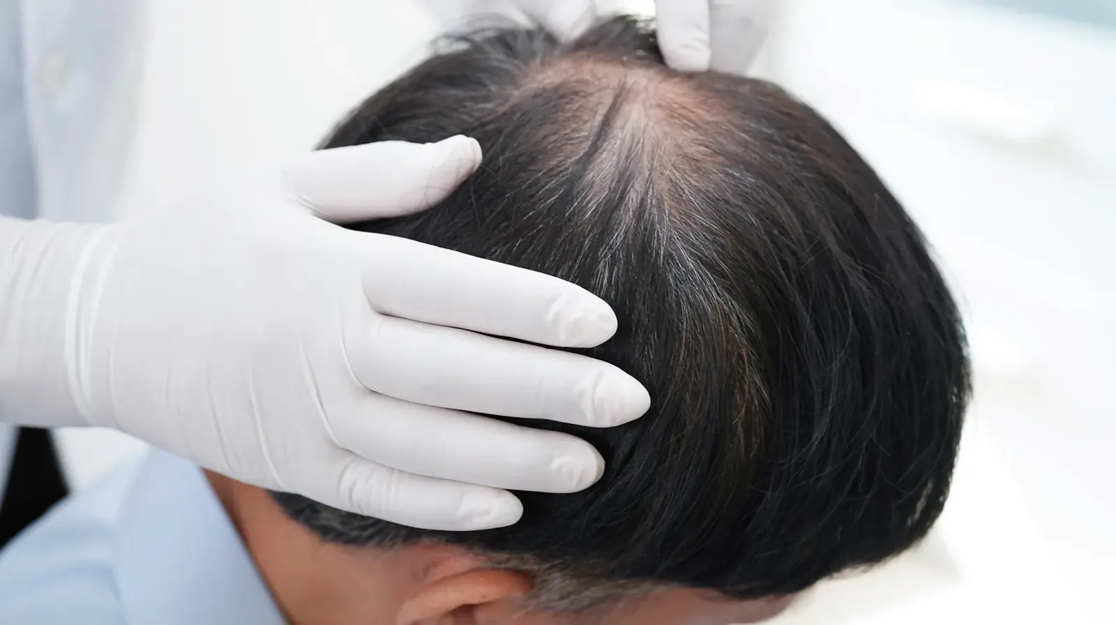 Hair Transplant