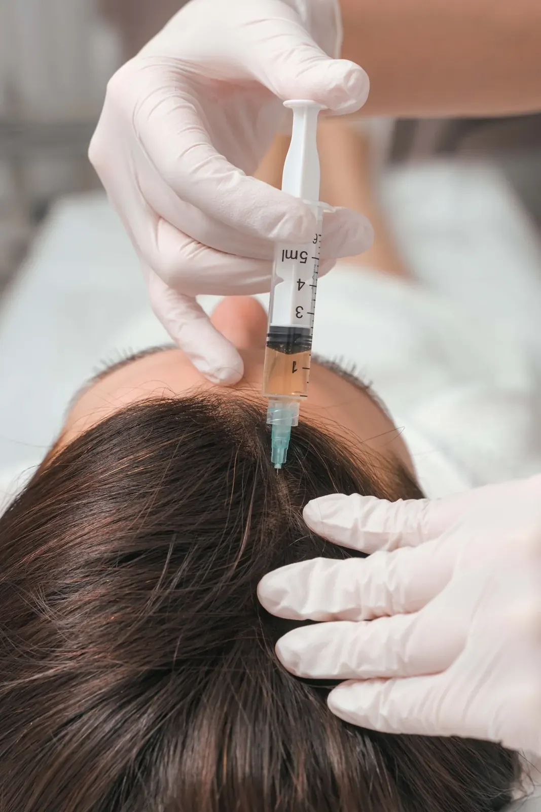 PRP Hair Follicle Activation
